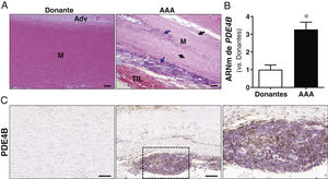 La expresión de PDE4B está aumentada en el AAA humano. A) Imágenes representativas de las tinciones de hematoxilina-eosina de muestras de aorta abdominal procedentes de donantes sanos (Donante) y pacientes con AAA (AAA) en la que se puede observar la desorganización de la pared vascular en esta enfermedad caracterizada por un importante infiltrado inflamatorio (flechas azules) y la pérdida de contenido en CMLV (flechas negras). Se indica la posición de la media (M), la adventicia (Adv) y el trombo intraluminal (TIL) que se detecta en la lesión aneurismática (Barras: 100μm). B) Cuantificación del nivel de mRNA de PDE4B en la aorta abdominal de donantes (n=15) y pacientes con AAA (n=27). Los resultados se muestran como media±SEM. *p<0,001 vs. donantes. C) Análisis inmunohistoquímico para PDE4B en dichas muestras. Se indica con un recuadro la región magnificada correspondiente al infiltrado inflamatorio positivo para PDE4B (Barras: 100μm).