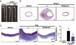 El tratamiento con rolipram atenúa la formación de AAA en ratones ApoE-/− infundidos con Ang II. Los ratones ApoE-/− se infundieron con solución salina (salino) o Ang II (1000 ng/kg/min) durante 28 días y se trataron o no con rolipram (Rol; 3mg/kg/día; i.p.). A) Imágenes macroscópicas de las aortas de cada uno de los grupos experimentales. B) Imágenes representativas de tinciones de hematoxilina-eosina de cortes de muestras de los grupos indicados en A (Barras: 200μm). C) Imágenes representativas de tinciones de tricrómico de Mason de cortes de muestras de los grupos indicados en A (Barras: 100μm). El histograma muestra la cuantificación del área positiva para colágeno. Los resultados se muestran como media±SEM p<0,05: * vs. salino; # vs. Ang II. (salino, n=5; Ang II, n=10; rolipram, n=6).