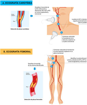 Estrategia ecográfica carotídea (A) y femoral (B). ACC: arteria carótida común; ACE: arteria carótida externa; ACI: arteria carótida interna; AFP: arteria femoral profunda; AFS: arteria femoral superficial.