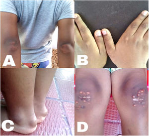 Lesiones cutáneas. A)Xantomas en codos. B)Xantomas en nudillos. C)Xantomas en retropié, a nivel de tendón de aquiles bilateral. D)Xantomas en ambas rodillas.