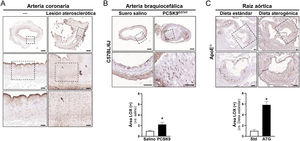 LOX aumenta en lesiones ateroscleróticas humanas y de modelos murinos. A)Imágenes representativas de los análisis inmunohistoquímicos para la LOX en arterias coronarias humanas sanas (izquierda) y con lesión aterosclerótica (derecha). Los paneles inferiores corresponden a la magnificación de las áreas indicadas en los paneles superiores. Barras: 500μm (panel superior), 100μm (panel central) y 50μm (panel inferior). B)Expresión de la LOX analizada mediante inmunohistoquímica y análisis cuantitativo de la inmunotinción de arterias braquiocefálicas de ratones C57BL/6J a los que se indujo aterosclerosis mediante transducción con PCSK9D374Y y dieta aterogénica, y de arterias sin lesión de animales que recibieron suero salino (s. salino n=5, PCSK9 n=8). Barras: 100μm (panel superior) y 50μm (panel inferior). C)Imágenes representativas y cuantificación de los análisis inmunohistoquímicos para la LOX en raíces aórticas de animales ApoE−/− alimentados con dieta estándar (Std) y dieta aterogénica (ATG) durante 12 semanas (n=4). Las imágenes inferiores muestran la magnificación de las áreas indicadas en los paneles superiores. Los resultados se expresan como media±SEM. *p<0,01 vs. s. salino o dieta Std. Barras: 100μm.