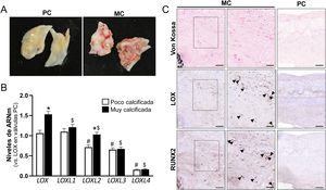 Expresión de LOX y de las isoenzimas LOX-like (LOXL) en válvulas aórticas humanas con distinto grado de calcificación. A)Imágenes representativas de válvulas aórticas humanas poco (PC) y muy calcificadas (MC). B)Niveles de ARNm de LOX y LOXL1-4 en válvulas PC (n=26; barras blancas) y MC (n=53; barras negras). Los resultados se expresan como media±SEM. p<0,05; *vs. válvulas aórticas PC; #vs. LOX en válvulas PC; $vs. LOX en válvulas MC. C)Imágenes representativas de la tinción de Von Kossa y análisis inmunohistoquímicos de LOX y RUNX2 en válvulas MC y PC. Los paneles de la derecha muestran la magnificación de las áreas indicadas en las imágenes de la izquierda. Barras: 100μm (panel derecho e izquierdo) y 50μm (panel central).