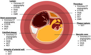 How different imaging modalities can be used to assess coronary plaque stability. Different components such as lumen of the artery, stent assessment, atherosclerotic plaques, integrity of the arterial wall, presence of thrombus, plaque rupture, and necrotic core could be identified. Figure complied from Refs.32–59. Diagram created with BioRender.com.