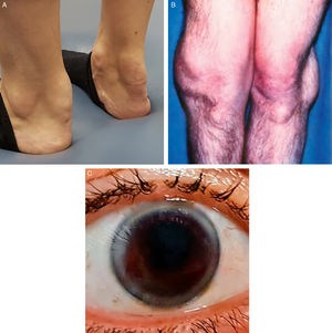Hallazgos de la exploración física en dislipemias primarias. A) xantomas tendinosos en un caso de betasitosterolemia (imagen cedida por el autor); B) xantomas pétreos en un caso de xantomatosis cerebrotendinosa11; C) arco corneal en una mujer de 25 años. Cedida por J. Mostaza.