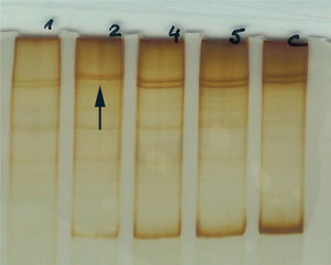 Electroforesis en gel de acrilamida. Exón 12D: se observa un cambio en el patrón en la muestra 2 respecto al control y al resto de muestras analizadas (flecha).