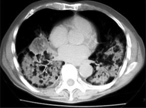 Tomografía axial computarizada de tórax tras 2 semanas de tratamiento antibiótico, donde se aprecia patrón de consolidación alveolar con imagen de masa pulmonar de aspecto heterogéneo y áreas de baja densidad.
