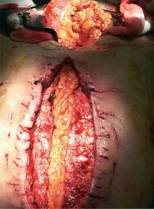 Omentoplastia en mediastino anterior con tunelización mediante laparotomía media supraumbilical.