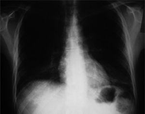 Radiografía de tórax en el momento del ingreso: infiltrados intersticiales de predominio en ambas bases pulmonares.