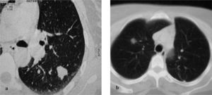 Tomografías computarizadas de tórax: a) se aprecia un nódulo pulmonar periférico en el lóbulo inferior izquierdo; b) se observa un nódulo pulmonar intraparenquimatoso en el lóbulo superior derecho.