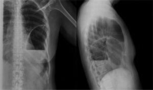 Radiografía simple de tórax (posteroanterior y lateral) de una rotura diafragmática traumática aguda, diagnosticada a las 15 horas de haberse producido.