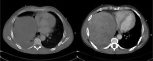 Tomografía computarizada de tórax, sin y con contraste yodado intravenoso, que muestra la elevación del hígado al hemitórax derecho. El diagnóstico en este caso se confirmó con toracoscopia previa a la toracotomía.