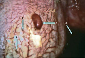 Foco de tejido endometrial en la pleura diafragmática. Visualización mediante videotoracoscopia de foco de endometriosis pleural con hematoma central (1), focos de endometriosis pleural de color pardusco (2) y restos de hemotórax en la cavidad pleural (3).