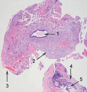 Aspecto histológico de tejido endometrial en la pleura diafragmática. 1: glándula endometrial de aspecto ondulante, en fase secretora del ciclo menstrual; 2: estroma endometrial; 3: aspecto vascular de estroma endometrial en fase secretora; 4: tejido de la pleura diafragmática, y 5: adipocitos de pleura parietal.