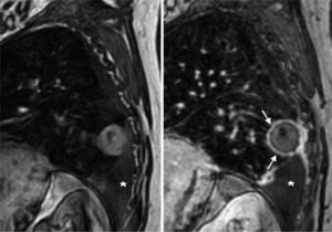 Resonancia magnética de un paciente en seguimiento por carcinoma pulmonar en estadio I, tratado hacía 9 meses con radiofrecuencia. Se observa un halo periférico en torno a la lesión, signo de progresión de la enfermedad.
