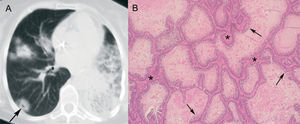 Carcinoma bronquioloalveolar en un paciente con tos crónica. A: tomografía computarizada de tórax donde se observan en el pulmón derecho nódulos con signo del halo, algunos con seudocavitación (flecha). En el pulmón izquierdo se aprecia una importante consolidación. B: imagen microscópica donde se observa cómo las células neoplásicas (flechas) tapizan los tabiques alveolares (asteriscos) (hematoxilina-eosina).