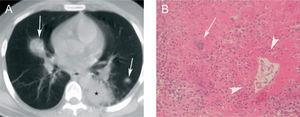 Granulomatosis de Wegener. A: imagen axial de tomografía computarizada donde se observan 2 nódulos pulmonares que muestran signo del halo (flechas), así como una consolidación en el lóbulo inferior izquierdo (asterisco), que se acompaña también de un área de atenuación en vidrio deslustrado. El paciente, que comenzó con hemoptisis, también presentaba una glomerulonefritis rápidamente progresiva. B: imagen microscópica donde se observa la infiltración inflamatoria de la pared arterial, con alguna célula gigante multinucleada (flecha) y desprendimiento endotelial (puntas de flecha) (hematoxilina-eosina).
