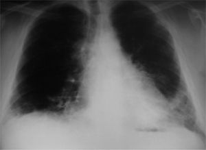 Radiografía de tórax posteroanterior, donde se aprecia en ambas bases pulmonares un infiltrado intersticial y reticular de predominio izquierdo.