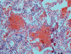 Poliangeítis microscópica: imagen de capilaritis y hemorragia alveolar en alas de mariposa. (HE, ×40.)