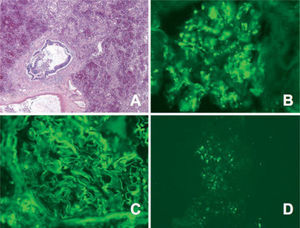 Hemorragia alveolar sin capilaritis en un caso de lupus eritematoso sistémico. (HE, ×10.) A, B y C: imágenes de inmunofluorescencia que evidencian doble depósito granular en el glomérulo renal (B: anticuerpo antiinmunoglobulina G; C: anti-C3. Aumentos originales: ×100). D: depósito granular en capilares pulmonares (anti-C3. Aumentos originales: ×340).