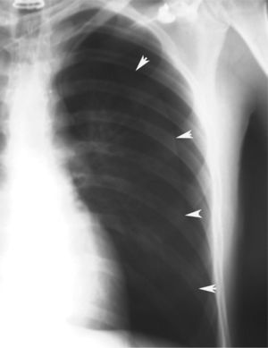 Neumotórax completo en el pulmón izquierdo.