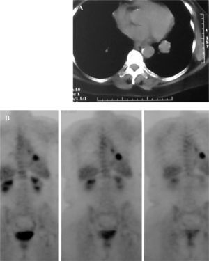 Metástasis pulmonar única en paciente intervenida por carcinoma de mama. En la tomografía computarizada se comprueba su localización en el lóbulo inferior izquierdo (A) y en la tomografía por emisión de positrones se confirma la sospecha (B).