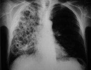Radiografía de tórax donde se observan varias cavitaciones en el pulmón derecho y pérdida de volumen de éste.