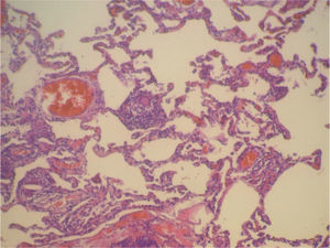 Neumonitis intersticial sin fibrosis de la pared alveolar (HE, ×60).