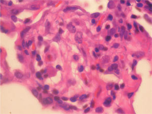 Granuloma de células epitelioides pobremente definido en un septo alveolar (HE, ×300).