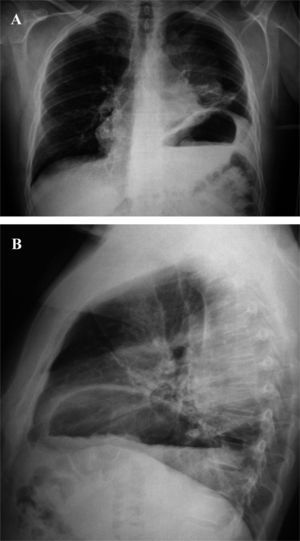 Radiografía posteroanterior (A) y lateral (B) de tórax, donde se identifica una masa paramediastínica posterior izquierda, así como elevación del diafragma homolateral.