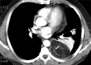 Tomografía computarizada que muestra, en la región posterior del hemitórax izquierdo, una masa con contenido graso y áreas lineales más densas (flecha) que comprime el pulmón adyacente.