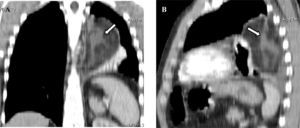 Tomografía computarizada con reconstrucciones coronal (A) y sagital (B), en la que se observa el gran lipoma mediastínico que comprime el pulmón. La densidad grasa del lipoma coexiste con zonas de más densidad (flecha).