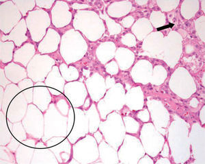 La histología demostró adipocitos necróticos (círculo) y reacción histiocitaria periférica (flecha).
