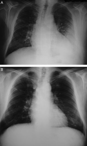 A: radiografía de tórax posteroanterior. Derrame pleural izquierdo. B: radiografía de tórax a los 10 meses de seguimiento, con desaparición del derrame pleural.