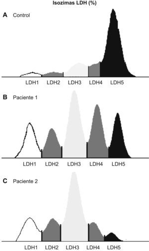 Distribución de las isoenzimas de la lactatodeshidrogenasa (LDH) en gel de agarosa: curva de un sujeto sano (A) y curvas de 2 pacientes con perfil distinto del de los controles (B y C).