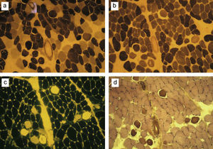 Secciones transversales consecutivas de microscopía óptica correspondientes a un animal del estudio: tinciones de adenosintrifosfatasa (ATPasa) a pH de 4,2 (a) y de 10,0 (b), e imágenes por fluorescencia de la muestra teñida con el colorante orange-dye (c) y por tinción simple de hematoxilina-eosina (d). Las fibras con el sarcolema dañado aparecen de color amarillo y marrón oscuro, respectivamente.