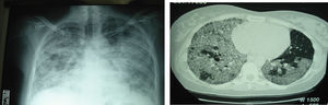 Radiografía de tórax a los 5 meses del segundo lavado pulmonar total. Inicio de tratamiento con factor estimulante de colonias de granulocitos y macrófagos por vía inhalada.