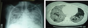 Radiografía de tórax a los 5 meses del segundo lavado pulmonar total. Inicio de tratamiento con factor estimulante de colonias de granulocitos y macrófagos por vía inhalada.