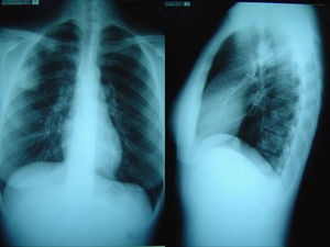 Radiografía simple del tórax.
