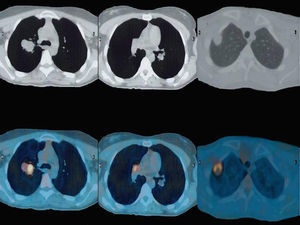 Tomografía por emisión de positrones-tomografía computarizada que muestran las lesiones pulmonares.