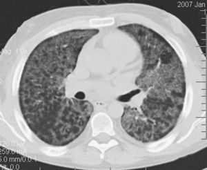La imagen de la tomografía computarizada de alta resolución muestra atenuación en vidrio deslustrado local, con superposición de engrosamiento septal intra e interlobular (denominado patrón en empedrado).