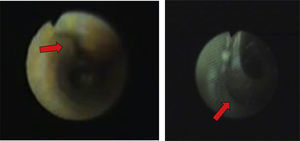 Muestra la fibrobroncoscopia de los dos pacientes. En el primer caso se evidenció una hendidura alargada en 1/3 superior de pared posterior de tráquea de 2×4mm de tamaño y en el segundo caso se observó una fisura traqueal de 4–5mm en región posterolateral del tercio superior de la tráquea.