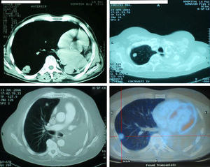 Casos 1 (12/5/1992), 2 (23/4/2003), 3 (13/7/2006) y 4 (22/12/2006), con lesiones periféricas en pulmón único.