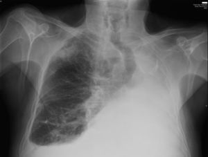 Radiografía del Servicio de Urgencias del caso 1 (12/9/2007). Se aprecia un infiltrado neumónico en el lóbulo superior derecho. El paciente falleció un mes después.