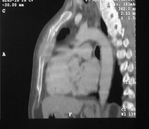 La tomografía computarizada mostró una masa lítica en el lado izquierdo del esternón. No había invasión mediastínica evidente.