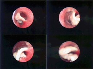 Imagen endoscópica de seudomembrana traqueal.
