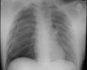 Radiografía posteroanterior de tórax: tubo de drenaje en el hemitórax izquierdo, con reexpansión completa de dicho pulmón y aparición de un nuevo neumotórax derecho de más de 3cm.