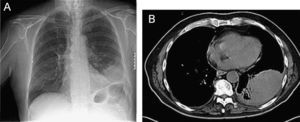 Radiografía de tórax (A) que muestra una imagen parenquimatosa redondeada, de 8cm, contornos bien definidos y localización posterior en el lóbulo inferior izquierdo, con derrame pleural. Tomografía computarizada (B) que muestra un absceso pulmonar por Leuconostoc spp.