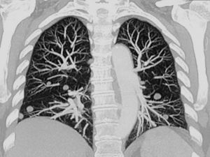 En la tomografía computarizada se aprecian nódulos pulmonares múltiples. En la imagen se señalan los nódulos resecados.