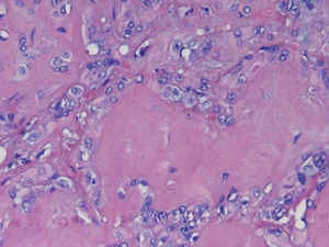 En la anatomía patológica se aprecian células neoplásicas de estirpe vascular que se disponen en nidos dentro de una matriz hialina.