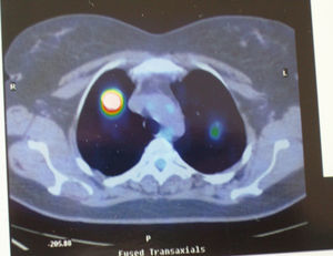 Tomografía por emisión de positrones: captación patológica de las lesiones de los vértices pulmonares.